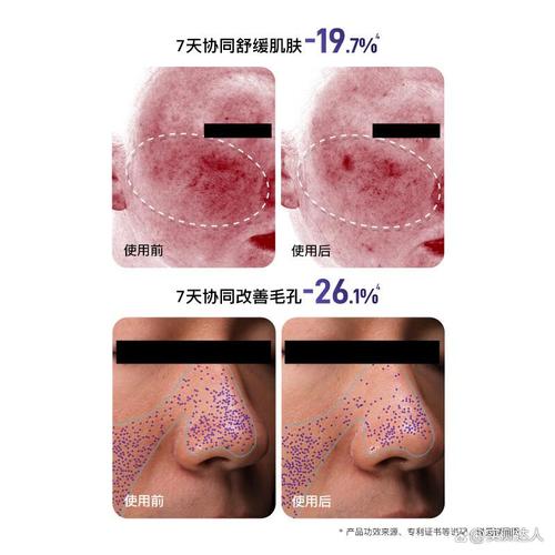 2026年美容仪品牌排行榜前10名 告别选择困难，轻松选对优质美容仪